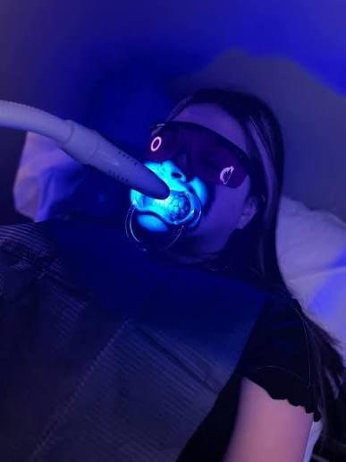 Before and after whitening